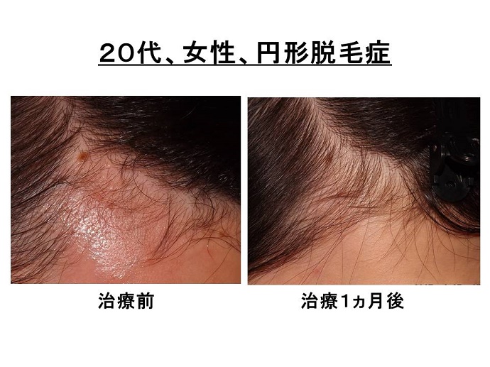 円形脱毛症　病院""